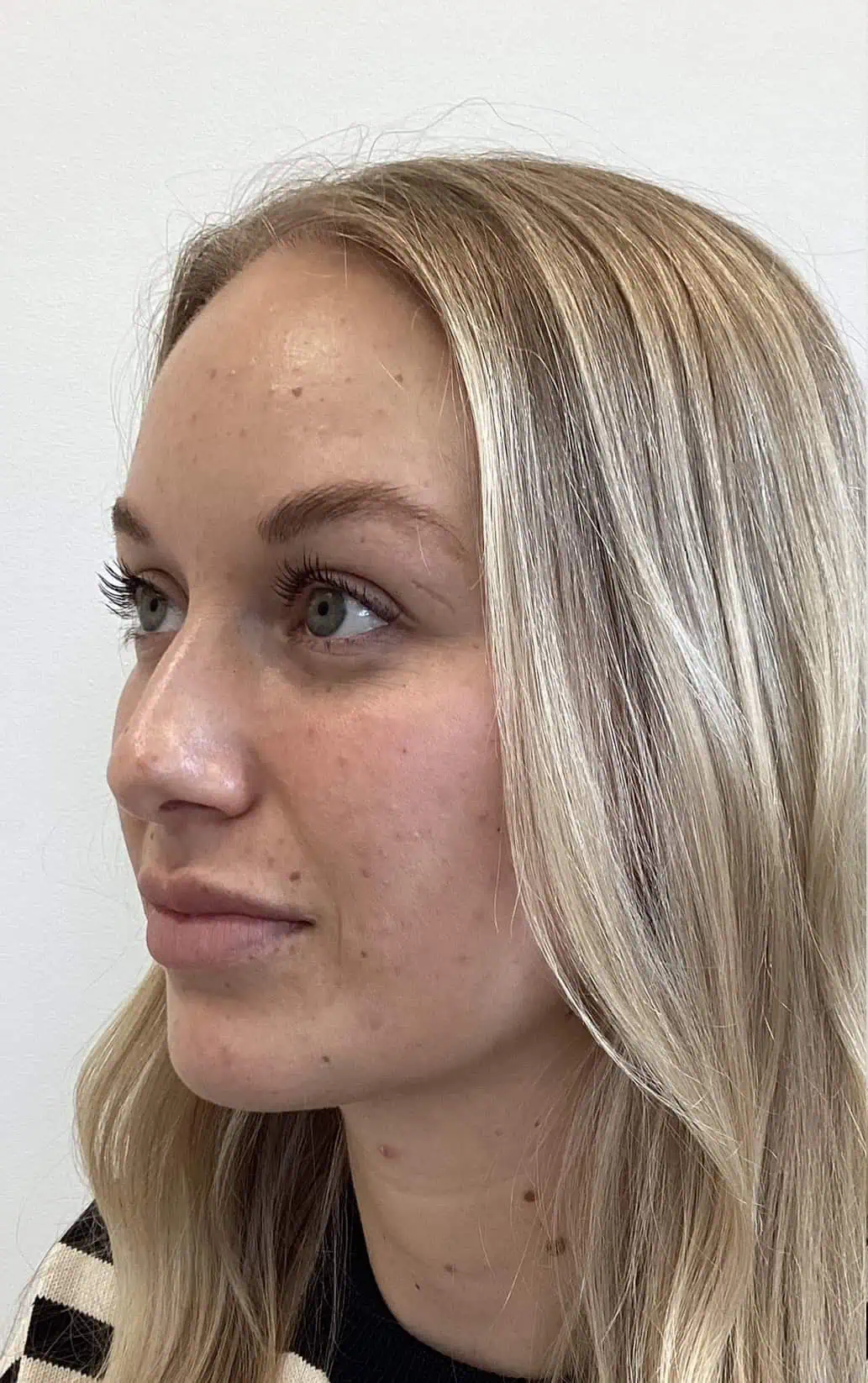 Lip Filler In Brentwood, TN 2 Lip filler before