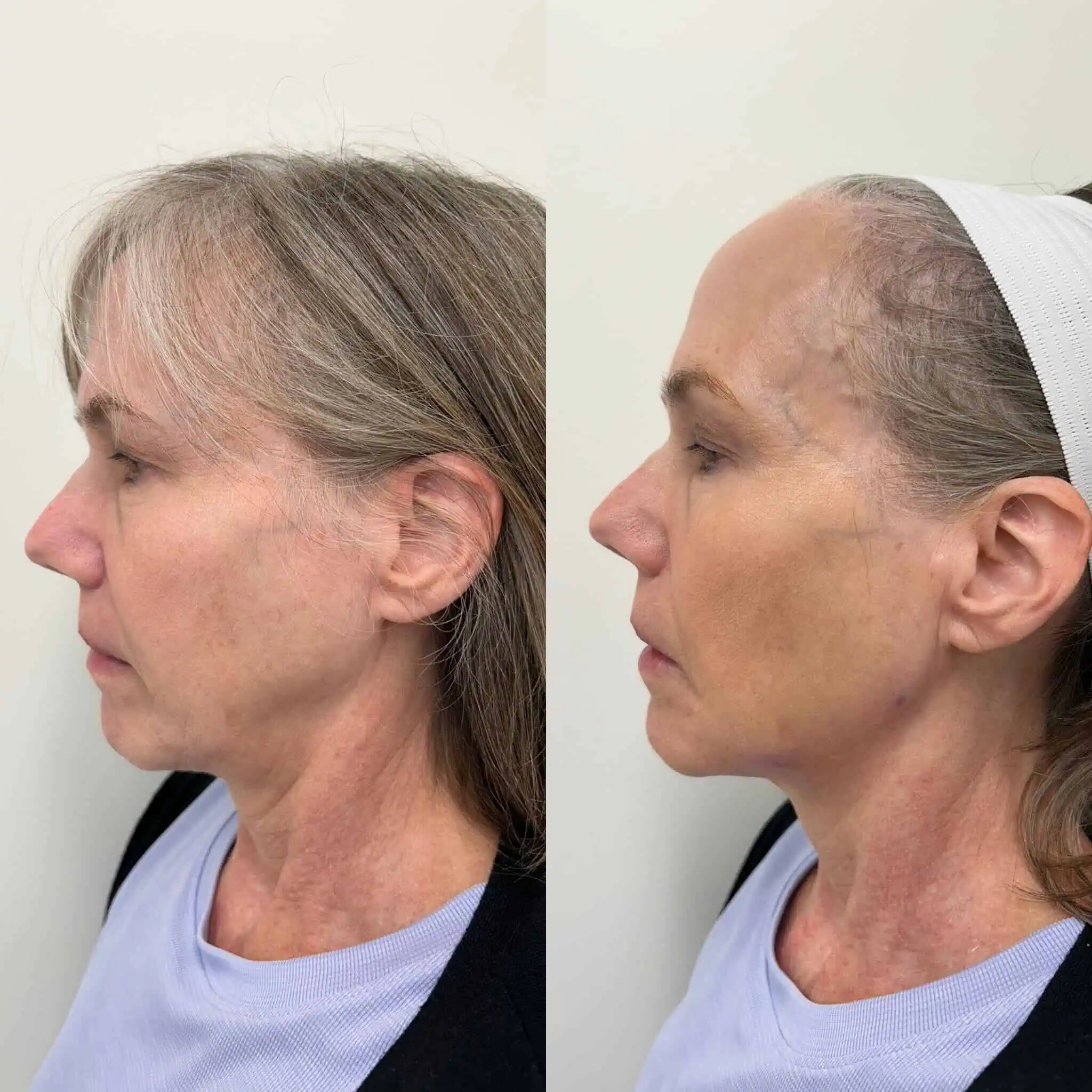 Radiesse Dermal Filler in Brentwood, TN 2 Radiesse
