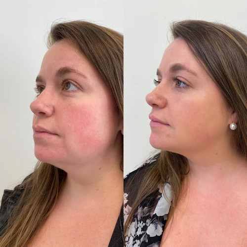 botox-dysport-xeomin-before-after-sunday-skin-aesthetics-brentwood-tn