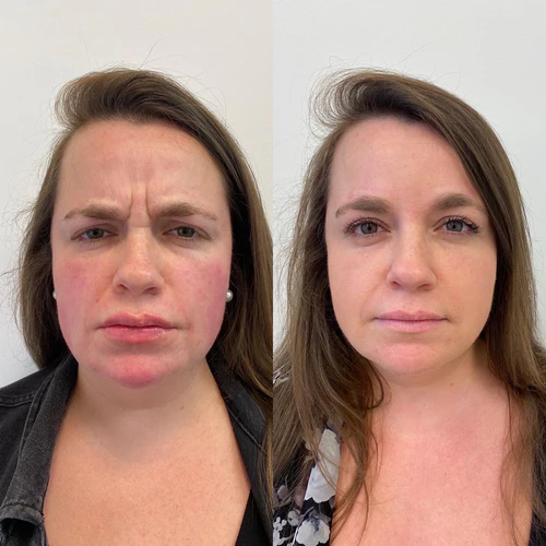 botox-dysport-xeomin-before-after-sunday-skin-aesthetics-brentwood-tn
