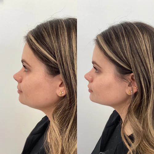 filler-before-afteR