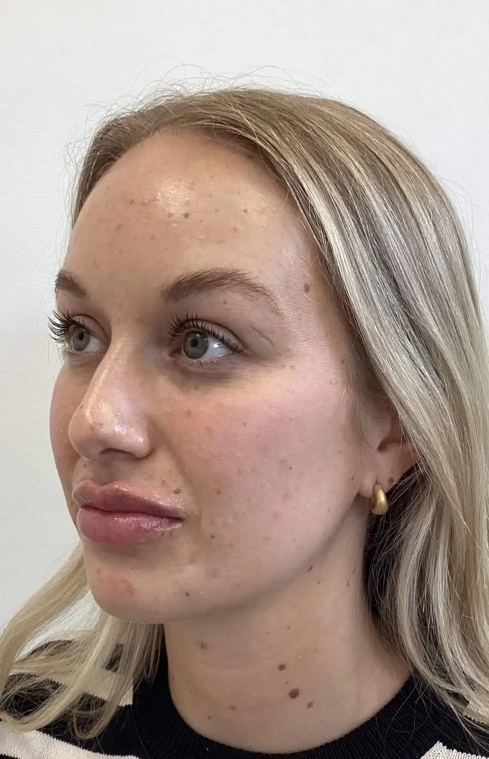 Lip Filler In Brentwood, TN 3 lip filler after