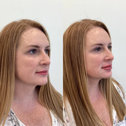 lip-filler-before-after