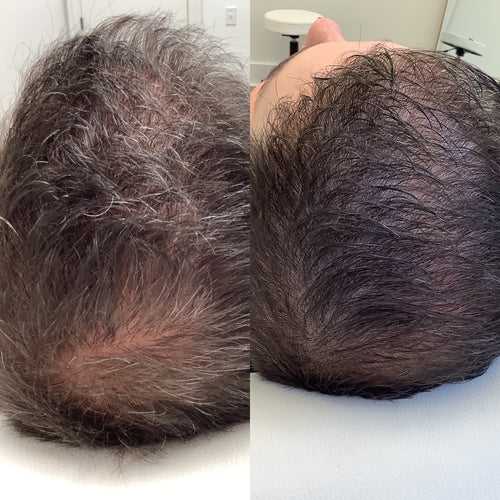 Scalp Treatments