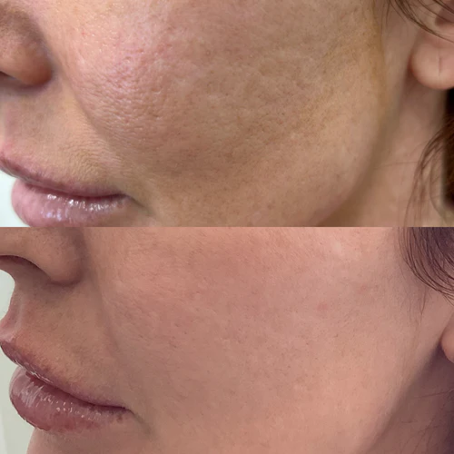 skinvive-before-after