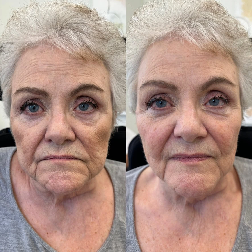 3-syringe-face-filler-before-after-sunday-skin-aesthetics-brentwood-tn