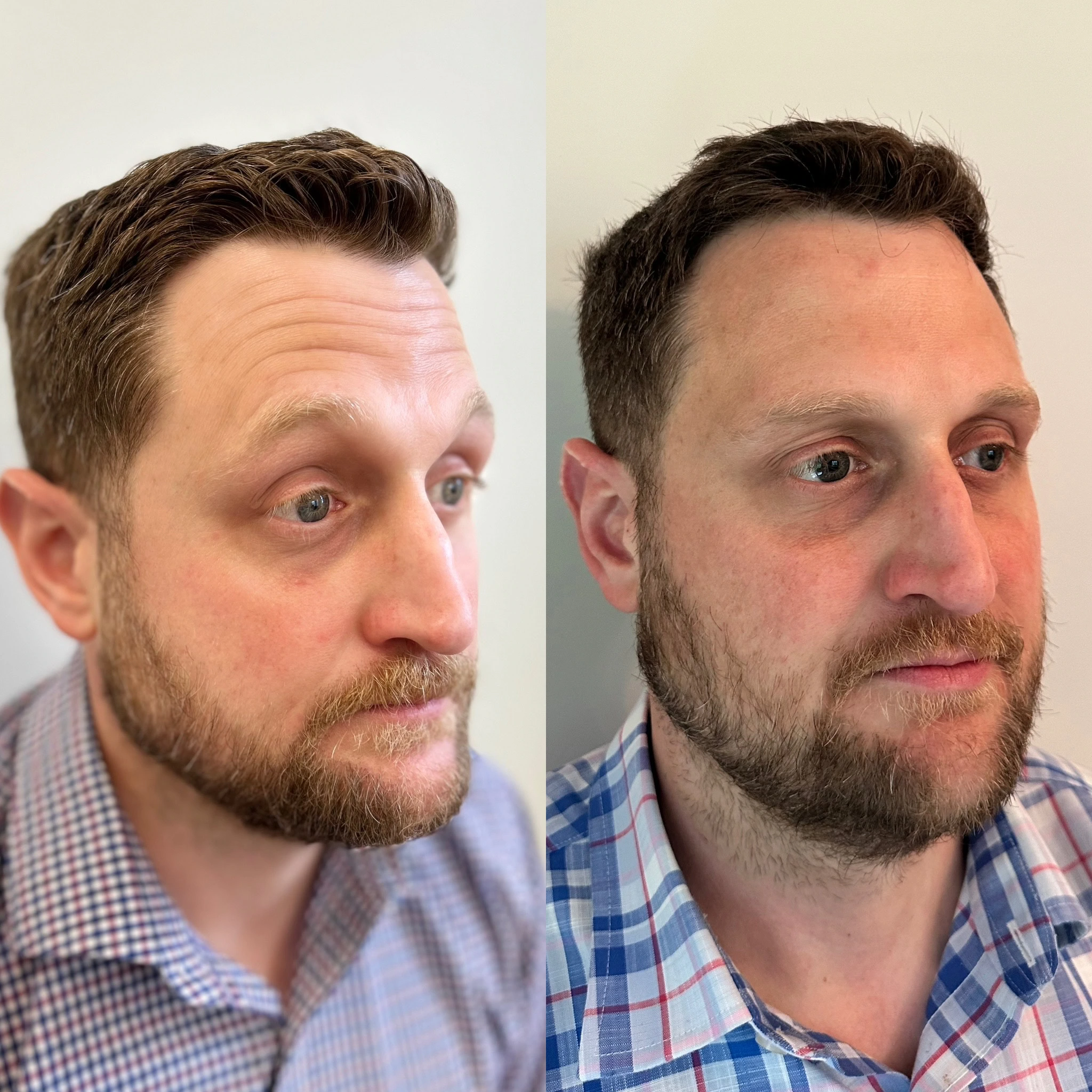 face-tox-before-after-sunday-skin-aesthetics-brentwood-tn-d