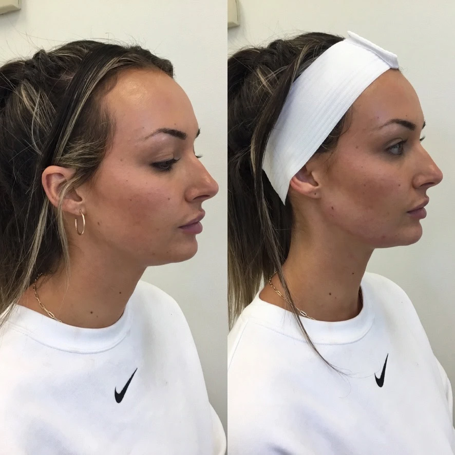 jawline-filler-before-after-sunday-skin-aesthetics-brentwood-tn