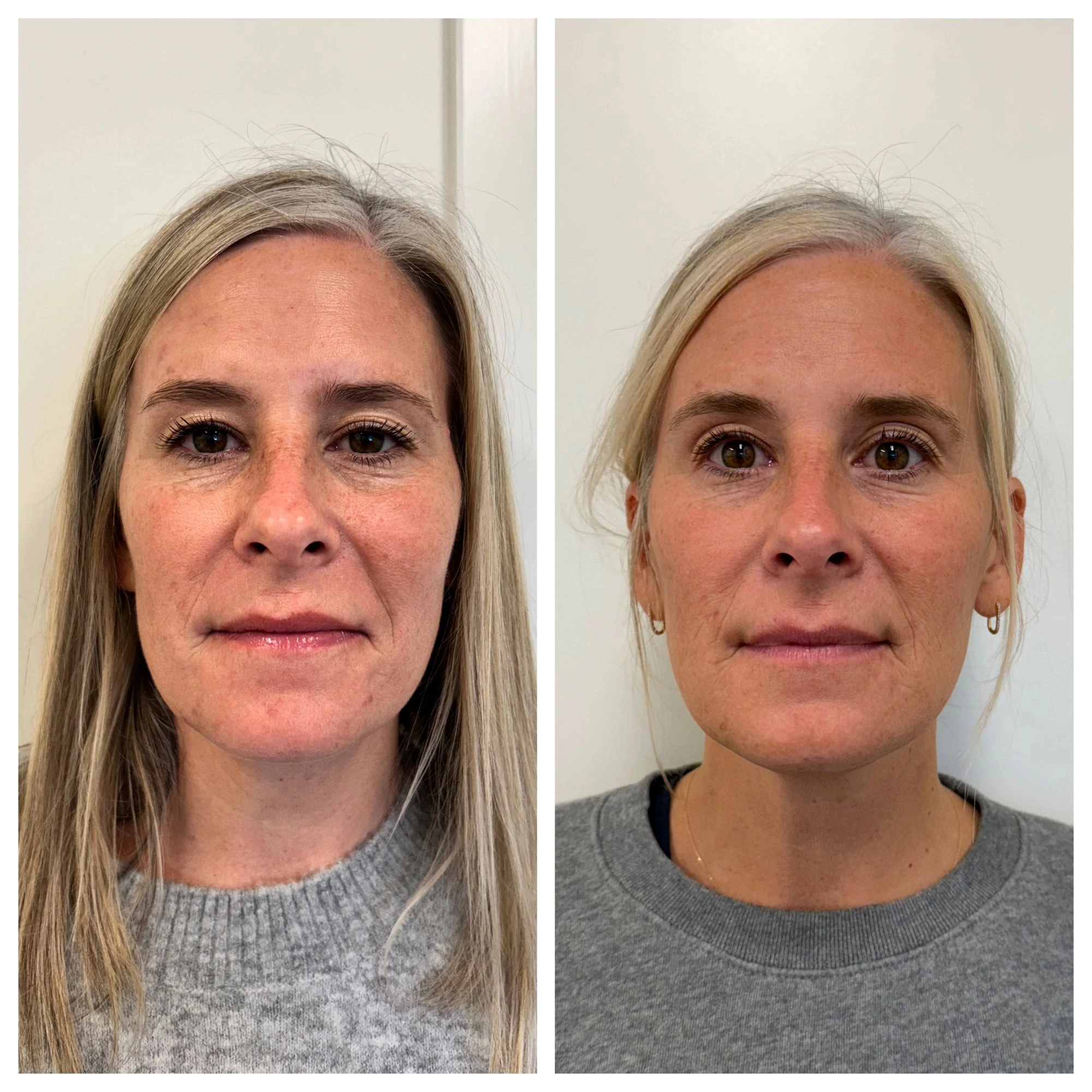 sculptra before after sunday skin aesthetics brentwood tn ea