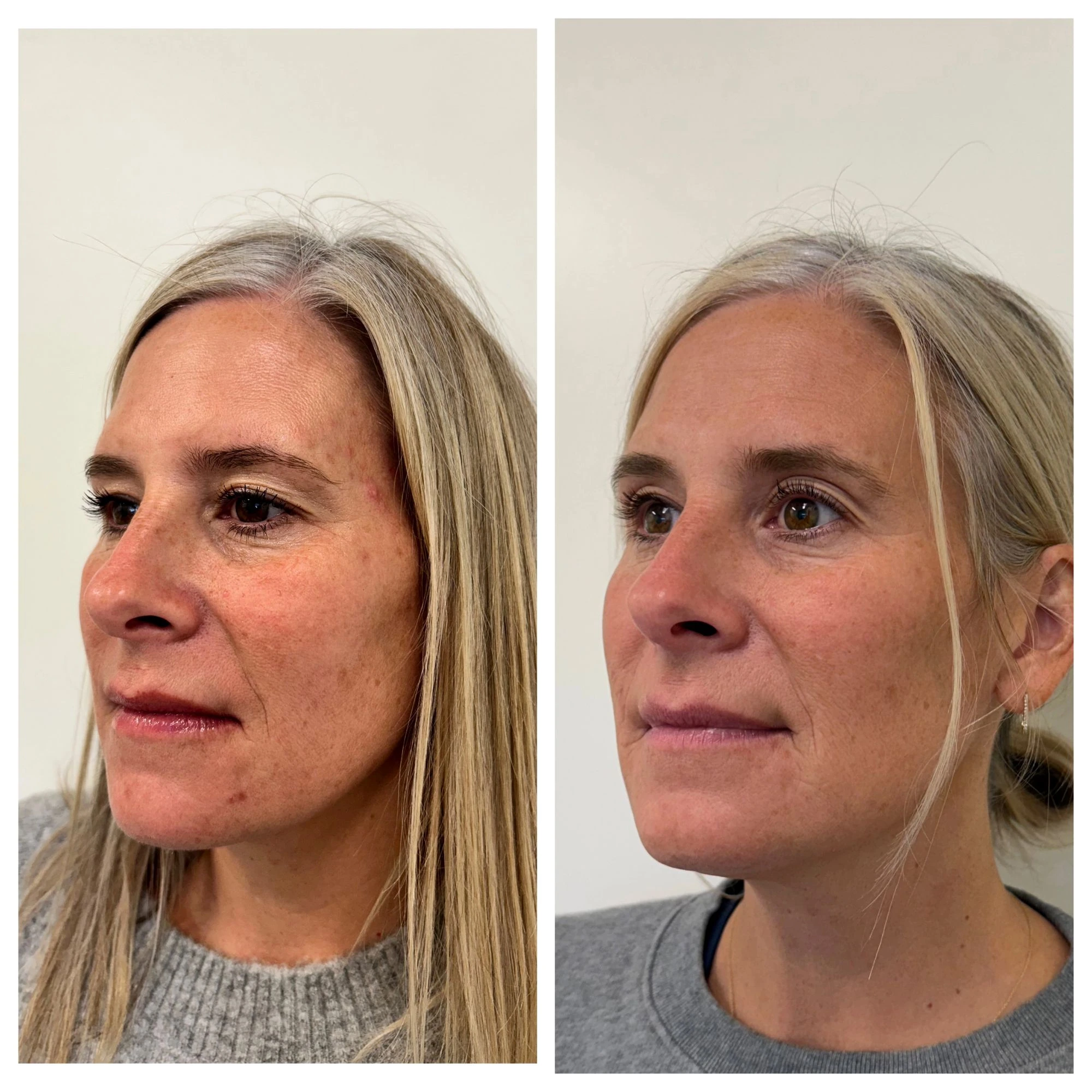 sculptra before after sunday skin aesthetics brentwood tn eb
