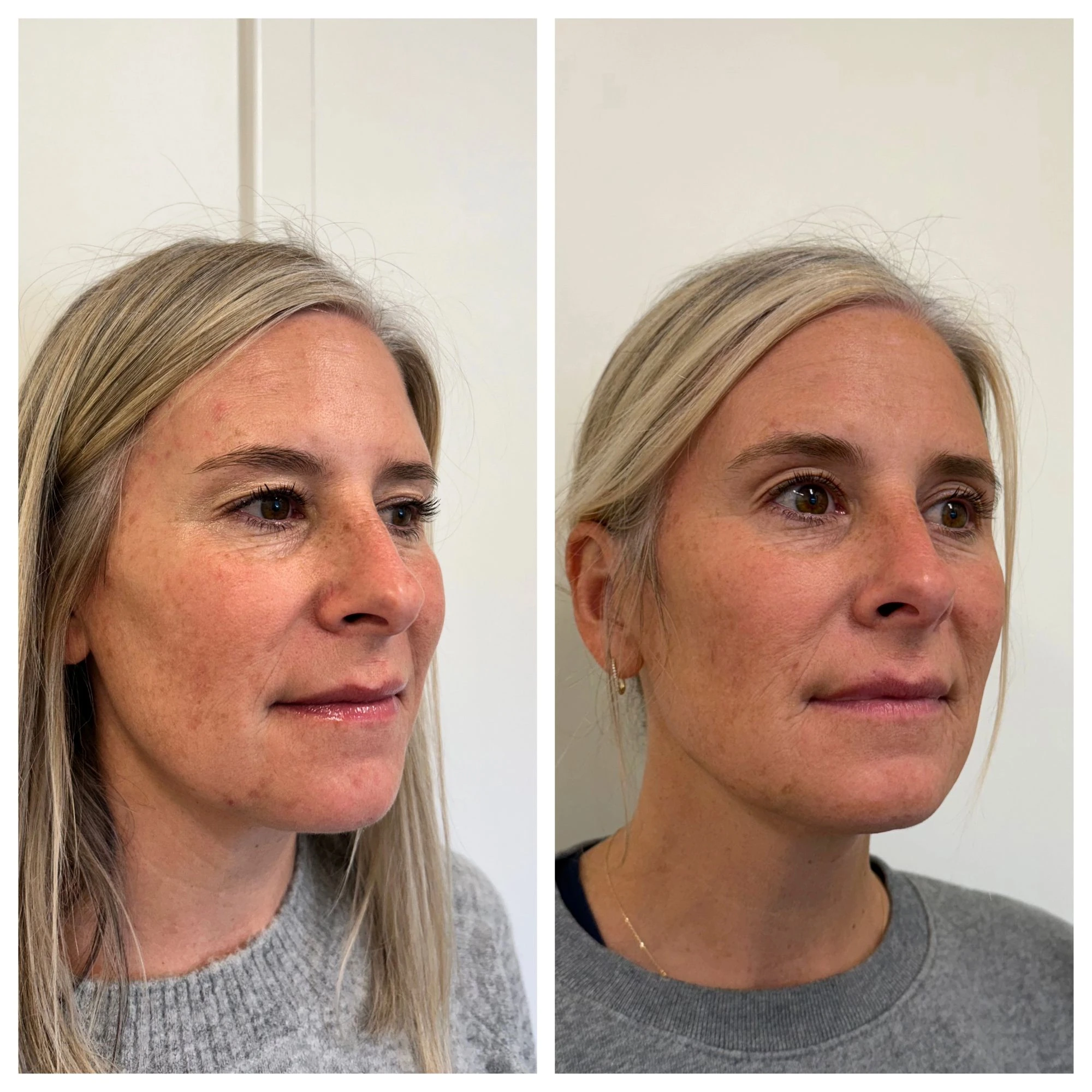 sculptra before after sunday skin aesthetics brentwood tn ec
