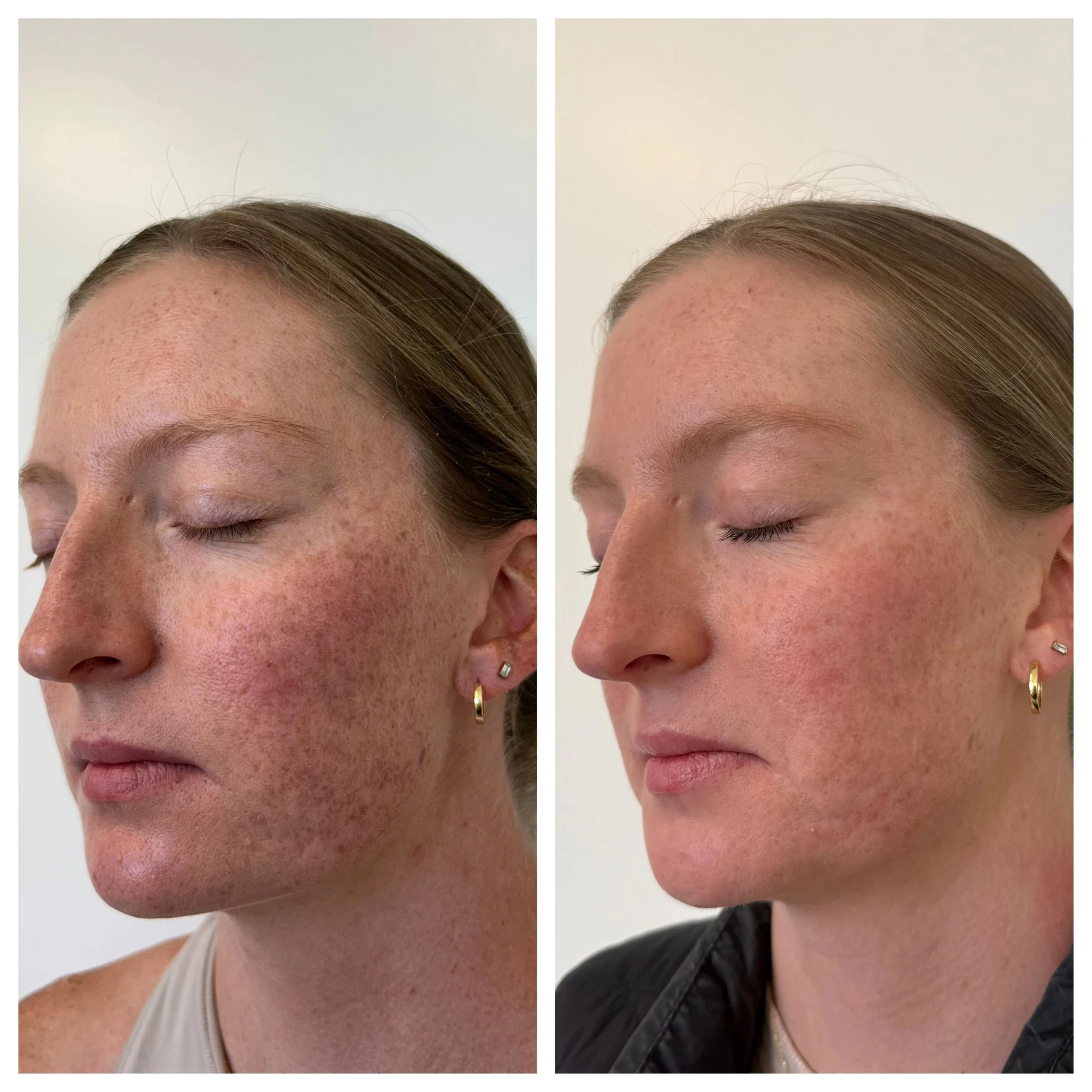 sculptra before after sunday skin aesthetics brentwood tn fb