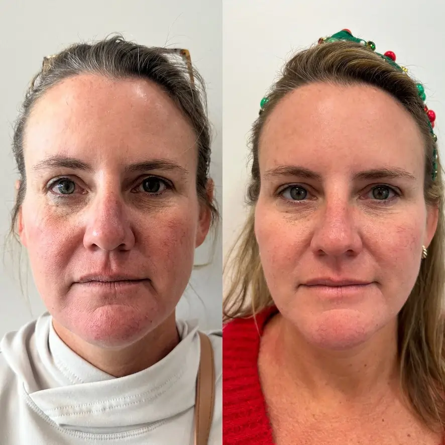 4 syringe face filler before after sunday skin aesthetics brentwood tn