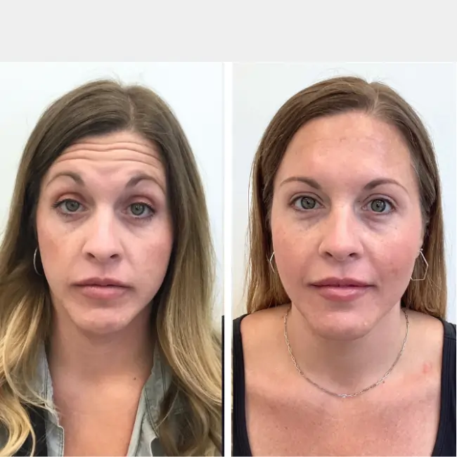botox before after sunday skin aesthetics brentwood tn e