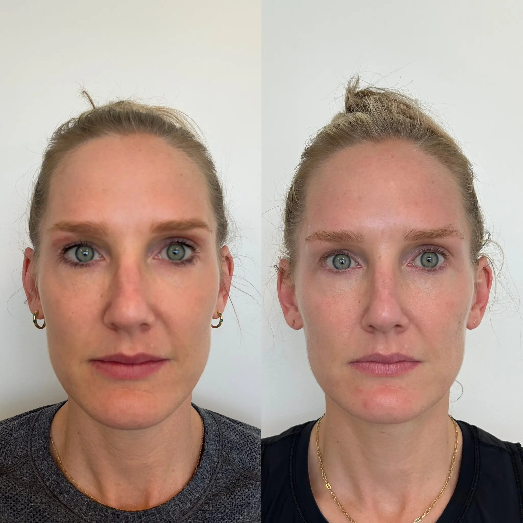 face sculptra before after sunday skin aesthetics brentwood tn d