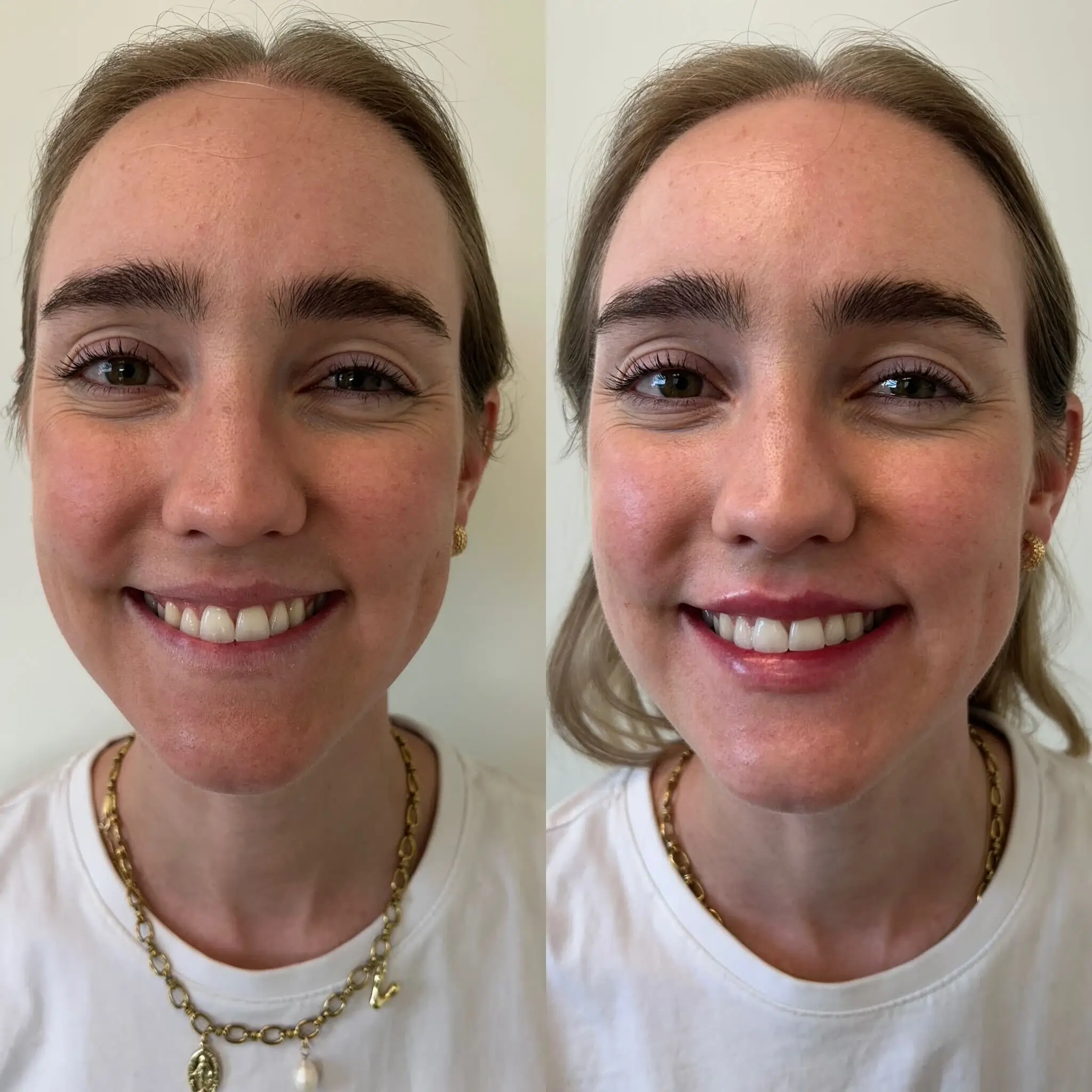 mini lip filler before after sunday skin aesthetics brentwood tn