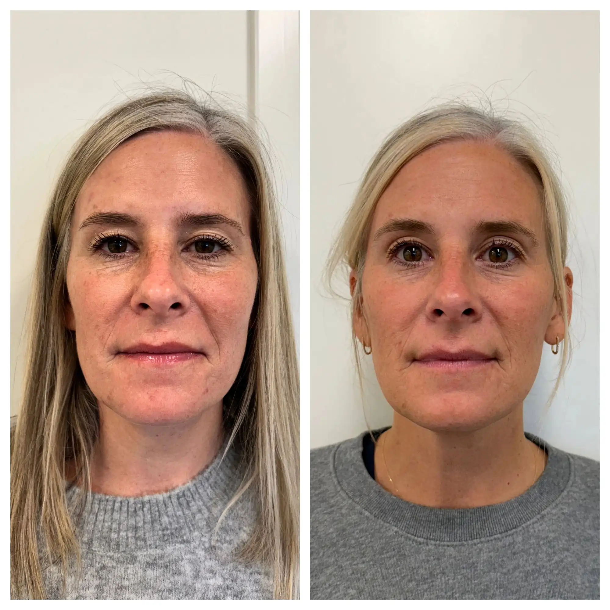 sculptra before after sunday skin aesthetics brentwood tn ea