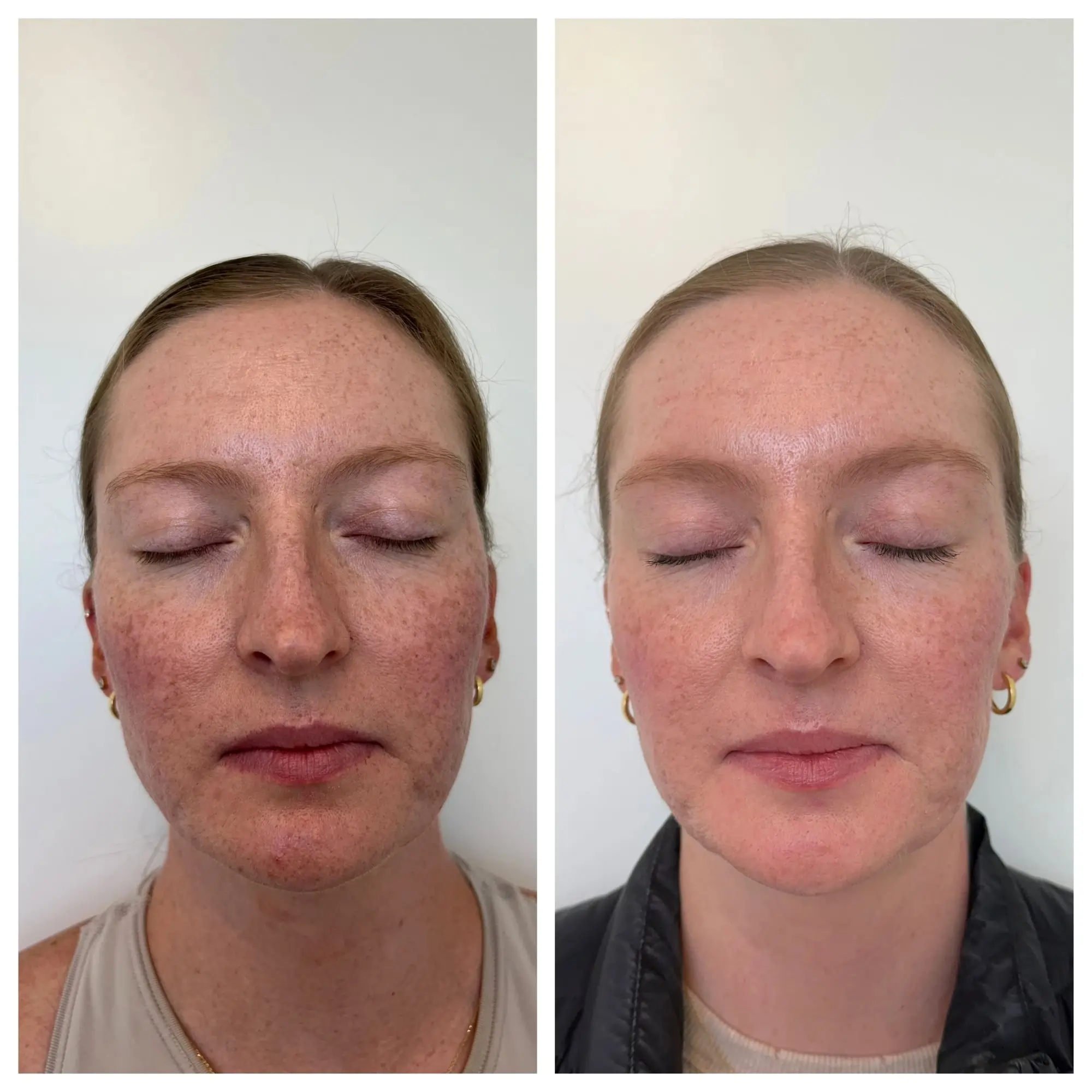 sculptra before after sunday skin aesthetics brentwood tn fa