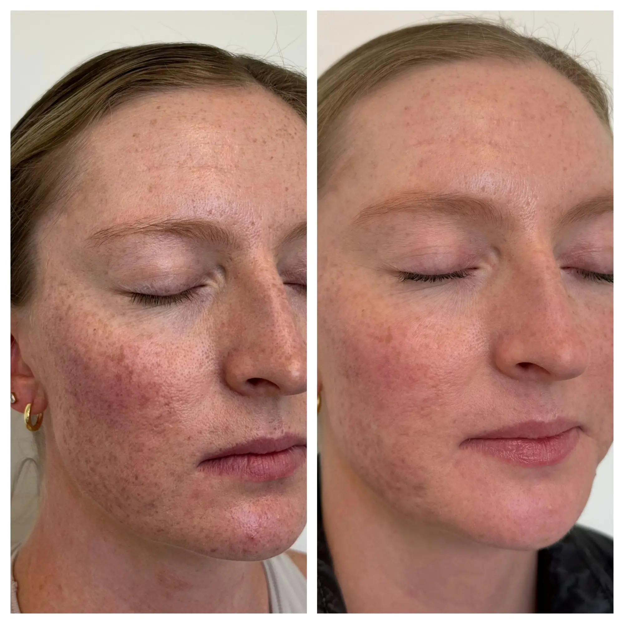 sculptra before after sunday skin aesthetics brentwood tn fc