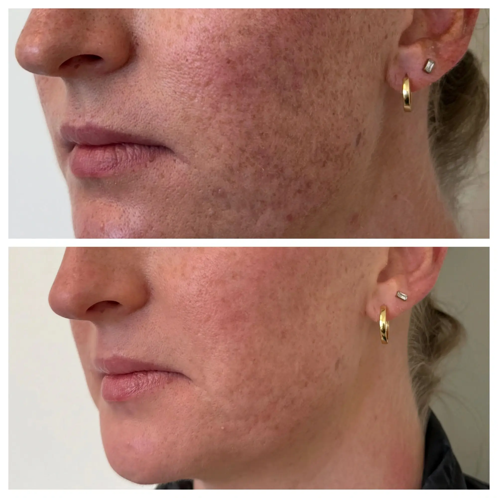 sculptra before after sunday skin aesthetics brentwood tn fd