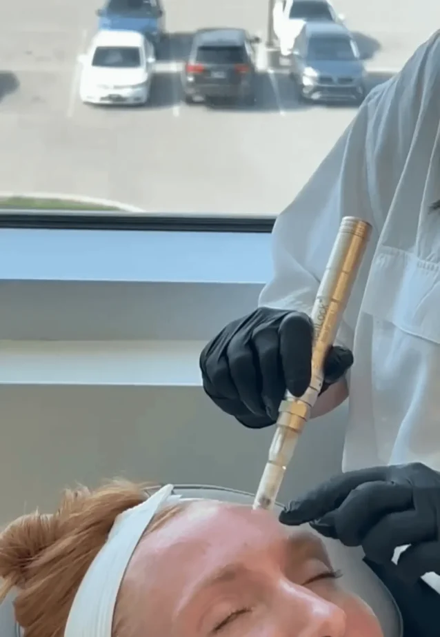 Microneedling in Brentwood, TN